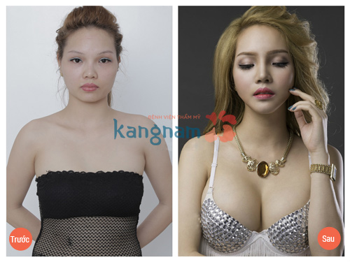 Kết quả hình ảnh cho site:phauthuatnguc.com.vn nâng ngực y line được bao lâu