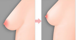 Nâng ngực chảy xệ sau sinh lấy lại vòng ngực đẹp cân đối 3
