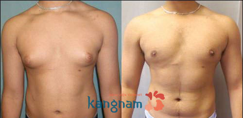 Kết quả nâng ngực cho nam giới tại kangnam