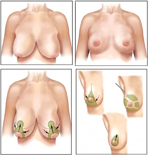 Phẫu thuật treo ngực sa trễ nâng ngực chảy xệ có để lại sẹo không