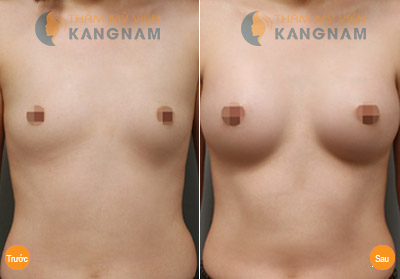 Cận cảnh quy trình nâng ngực không phẫu thuật bằng mỡ tự thân6