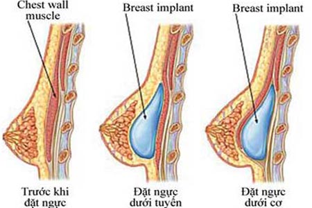 Túi độn ngực được đặt trên hoặc dưới cơ ngực lớn
