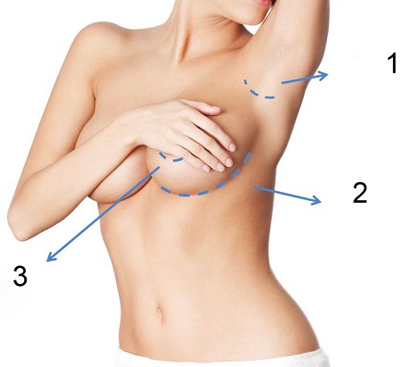 Liệu nâng ngực có hại không?