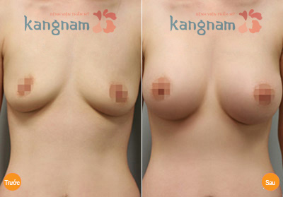 Kết quả nâng ngực sa trễ tại Bệnh viện thẩm mỹ Kangnam