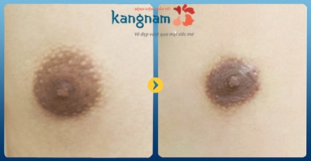Thu nhỏ quầng vú tại Kangnam có an toàn không?