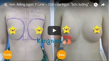 Cận cảnh kết quả nâng ngực Y line thay đổi diện mạo tại Kangnam