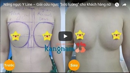 [FULL CLIP]: Video livetream ca phẫu thuật nâng ngực nội soi Nano Chip tại Kangnam