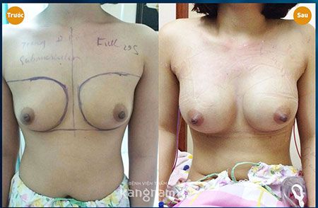 Phẫu thuật nâng ngực bằng mỡ tự thân bao nhiêu tiền1