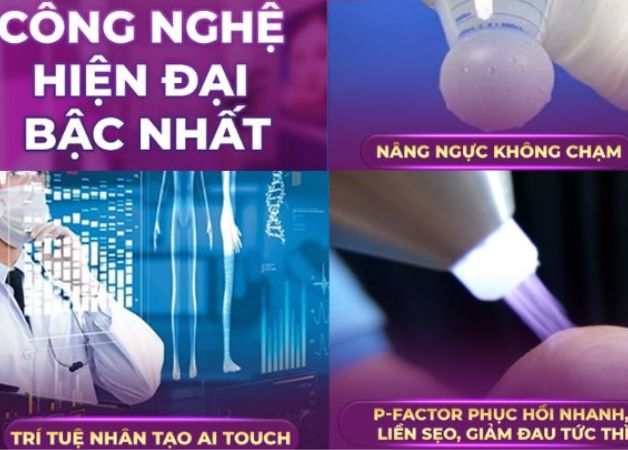 Nâng ngực bằng công nghệ Thai X-Breast